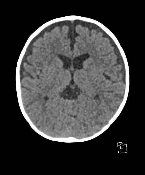 File:Benign enlargement of subarachnoid spaces in infancy (BESS) (Radiopaedia 87459-103795 Axial non-contrast 46).jpg