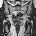 Bicornuate uterus (Radiopaedia 11104-11492 Coronal T2 20).jpg