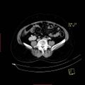 Bifid ureter (Radiopaedia 47604-52253 Axial C+ delayed 16).jpg