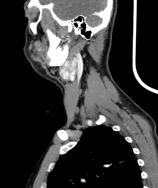 File:Bilateral carotid body tumors (Radiopaedia 52899-58827 C 5).jpg