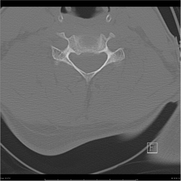 File:Bilateral cervical ribs (Radiopaedia 25868-26017 Axial bone window 30).jpg