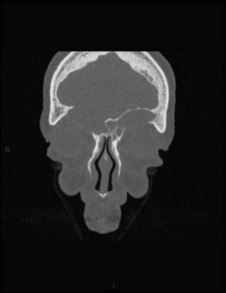 File:Bilateral frontal mucoceles (Radiopaedia 82352-96454 Coronal 75).jpg