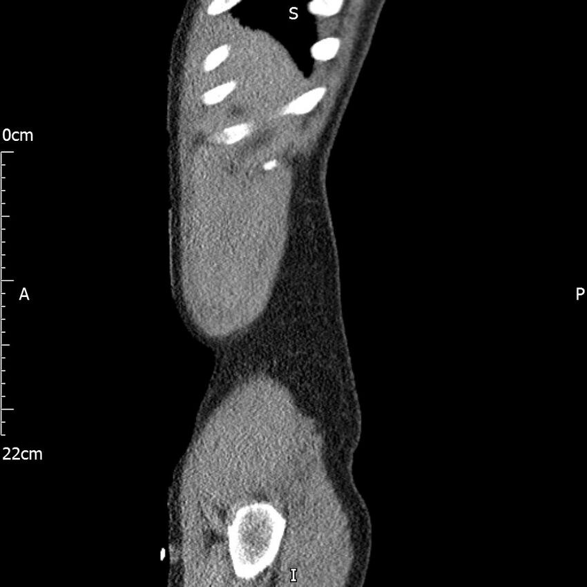 Bilateral medullary nephrocalcinosis with ureteric calculi (Radiopaedia 71269-81569 C 105).jpg