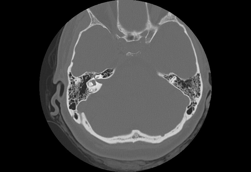 Bilateral otospongiosis (Radiopaedia 35447-36940 B 37).jpg
