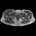 Bilateral ovarian fibroma (Radiopaedia 44568-48293 Axial T1 31).jpg