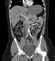 Bilateral ovarian mature cystic teratomas (Radiopaedia 79373-92457 B 27).jpg
