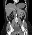 Bilateral ovarian mature cystic teratomas (Radiopaedia 79373-92457 B 34).jpg