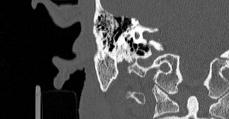 File:Bilateral temporal bone fractures (Radiopaedia 29482-29970 Coronal non-contrast 122).jpg