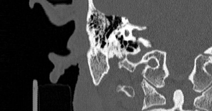 Bilateral temporal bone fractures (Radiopaedia 29482-29970 Coronal non-contrast 122).jpg