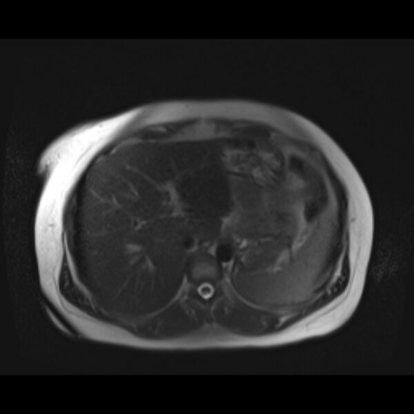 File:Bilobed placenta accreta (Radiopaedia 69648-79591 Axial T2 fat sat 3).jpg