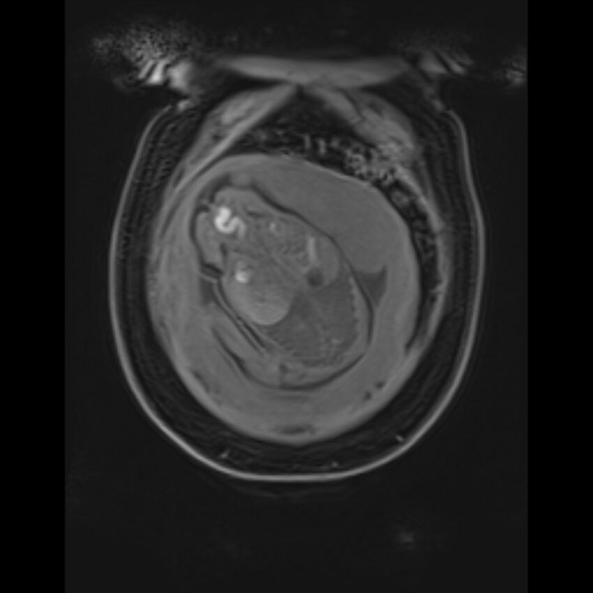 Bilobed placenta accreta (Radiopaedia 69648-79591 Coronal T1 vibe 32).jpg