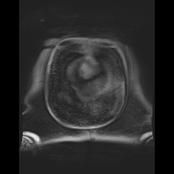 File:Bilobed placenta accreta (Radiopaedia 69648-79591 Coronal T1 vibe 6).jpg