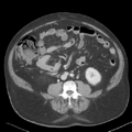 Bladder papillary urothelial carcinoma (Radiopaedia 48119-52951 Axial 30).png