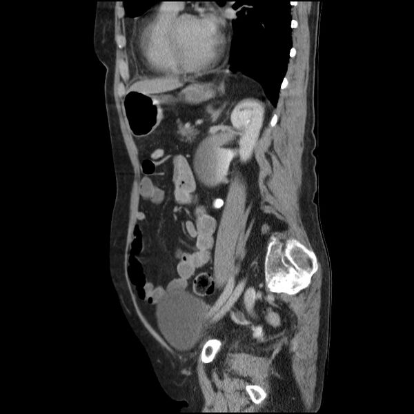 File:Bladder tumor detected on trauma CT (Radiopaedia 51809-57609 E 26).jpg