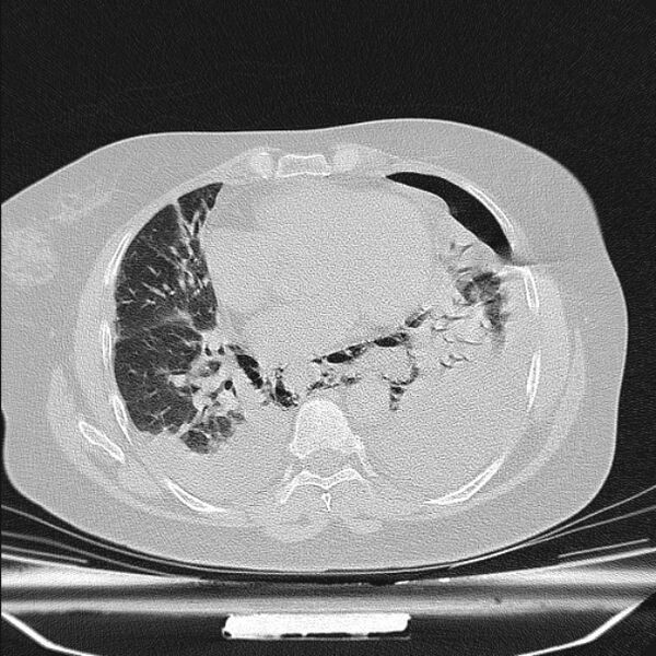 File:Boerhaave syndrome (Radiopaedia 45644-49799 Axial lung window 75).jpg