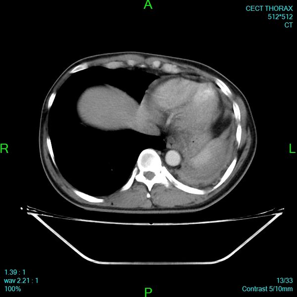 File:Bone metastases from lung carcinoma (Radiopaedia 54703-60937 Axial C+ delayed 13).jpg