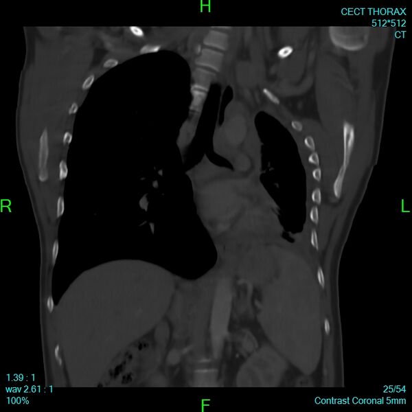 File:Bone metastases from lung carcinoma (Radiopaedia 54703-60937 Coronal bone window 25).jpg