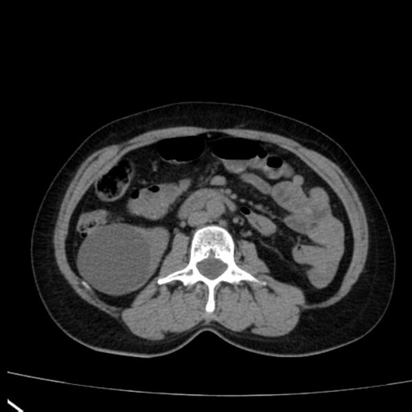 File:Bosniak renal cyst - type I (Radiopaedia 27479-27675 Axial non-contrast 45).jpg