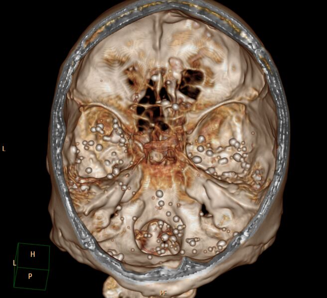 File:Brain Pantopaque remnants (Radiopaedia 78403-91048 3D VRT 2).jpg