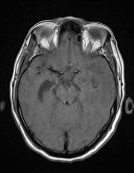 File:Brain abscess with ventriculitis (Radiopaedia 85703-101495 Axial T1 10).jpg