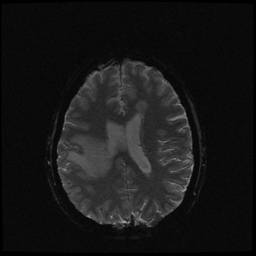 Brain metastases (renal cell carcinoma) (Radiopaedia 42571-45704 Axial SWI 20).jpg