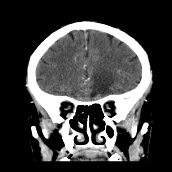 File:Brain metastases from lung cancer (Radiopaedia 24480-24781 Coronal C+ delayed 18).jpg