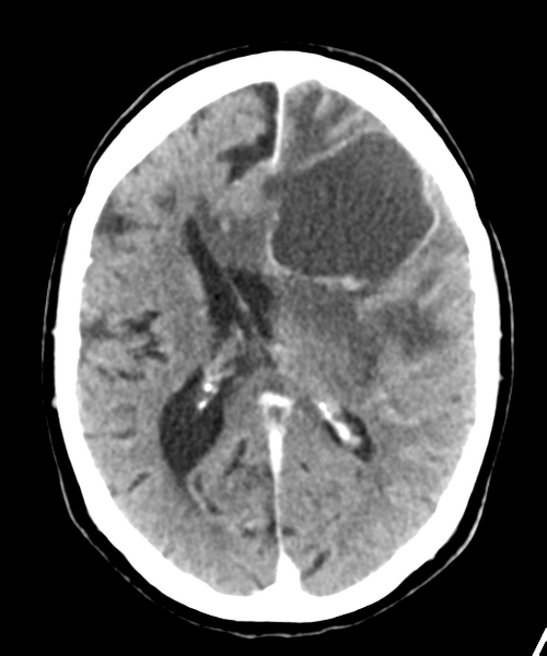 File:Brain metastasis (lung cancer) (Radiopaedia 48289-53177 Axial C+ 18).png