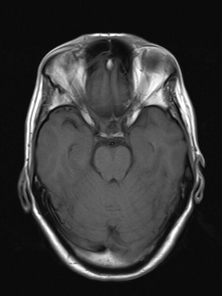 File:Brain metastasis as initial presentation of non-small cell lung cancer (Radiopaedia 65122-74126 Axial T1 8).jpg