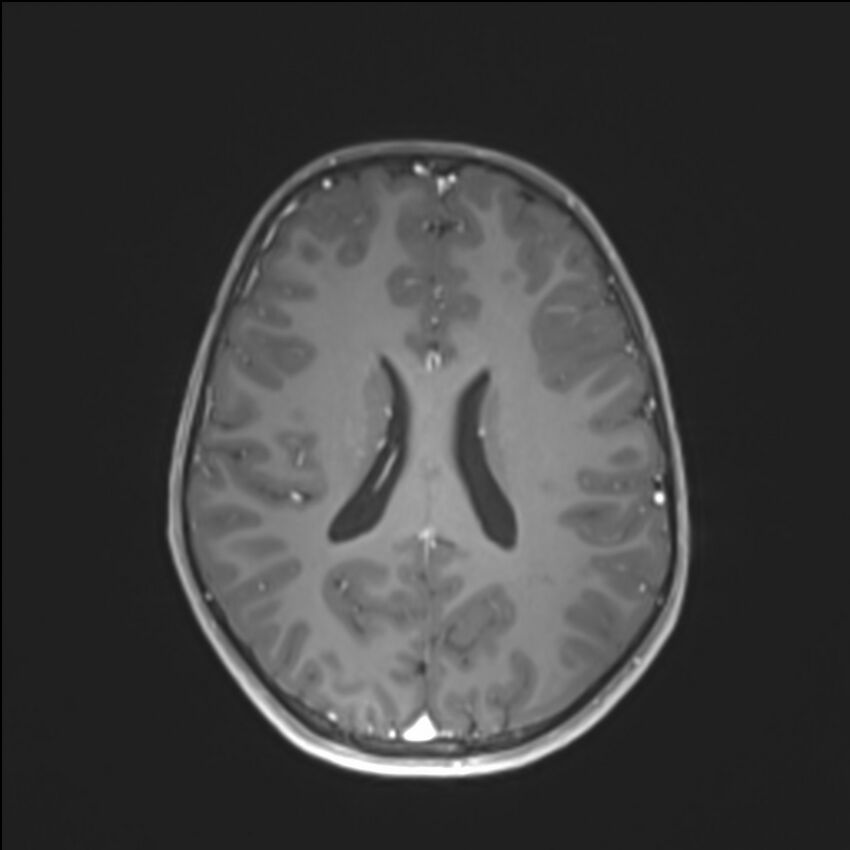 Brainstem glioma (Radiopaedia 70548-80674 Axial T1 C+ 100).jpg