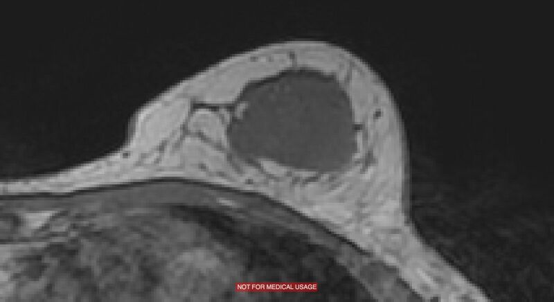 File:Breast lymphoma (MRI) (Radiopaedia 34999-36498 Axial T1 15).jpg