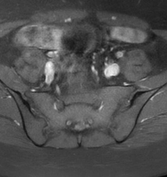 File:Broad ligament leiomyoma (Radiopaedia 81634-95516 Axial T1 C+ fat sat 3).jpg