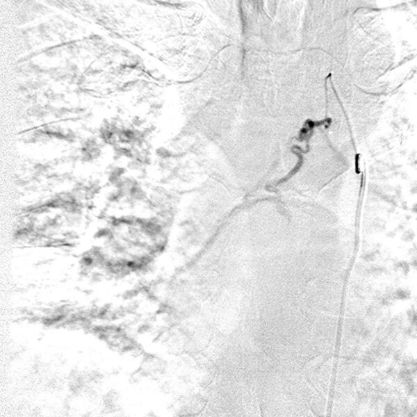 File:Bronchial arterial aneurysm (Radiopaedia 22293-22331 A 1).jpg
