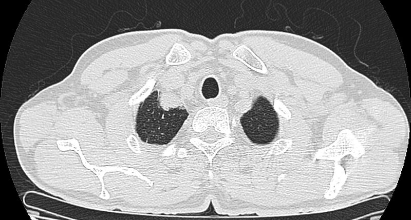 File:Bronchogenic carcinoma with superior vena cava syndrome (Radiopaedia 36497-38054 Axial lung window 8).jpg