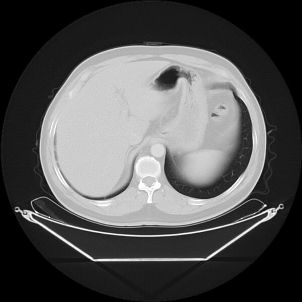 File:Bronchogenic carcinoma with upper lobe collapse (Radiopaedia 29297-29726 Axial lung window 30).jpg