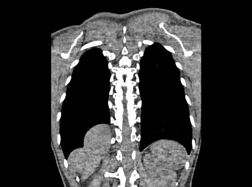 Bronchogenic cyst (Radiopaedia 80273-93615 D 123).jpg