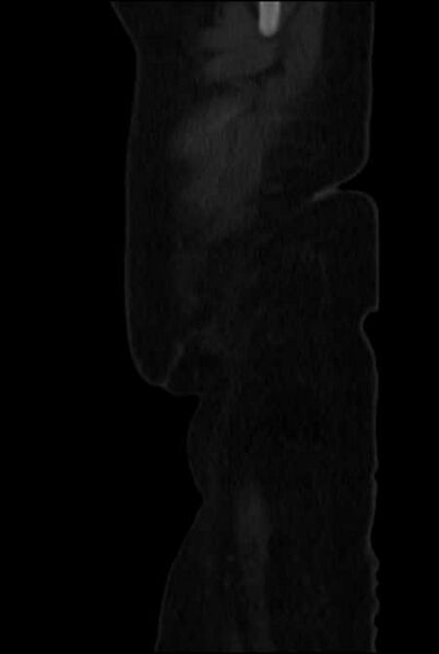 File:Brown tumors compressing the spinal cord (Radiopaedia 68442-77988 H 3).jpg