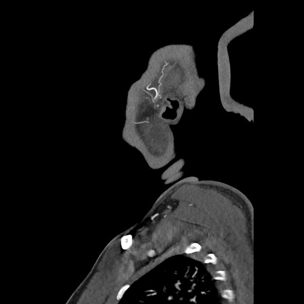 File:Buccal fat pad arteriovenous malformation (Radiopaedia 70936-81144 C 21).jpg