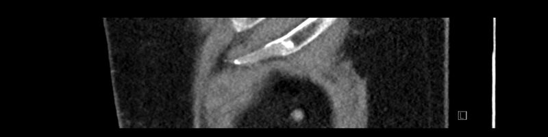 File:Buried bumper syndrome - gastrostomy tube (Radiopaedia 63843-72575 Sagittal Inject 7).jpg