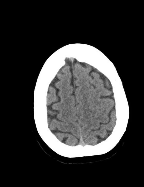 File:Burnt-out meningioma (Radiopaedia 51557-57337 Axial non-contrast 38).jpg