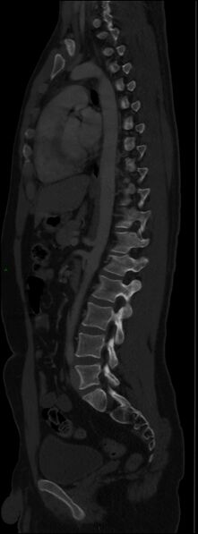 File:Burst fracture (Radiopaedia 83168-97542 Sagittal bone window 73).jpg