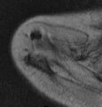 Calcific tendinopathy - supraspinatus (Radiopaedia 13440-13394 Axial Gradient Echo 1).jpg