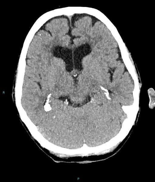 File:Calcified cerebral emboli from left ventricular thrombus (Radiopaedia 84420-99758 B 11).jpg