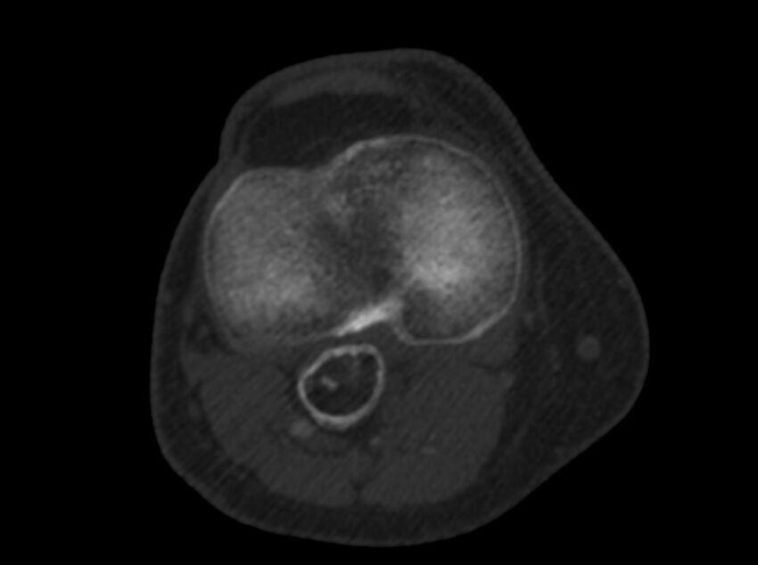 Calcified hematoma - popliteal fossa (Radiopaedia 63938-72763 C 35).jpg