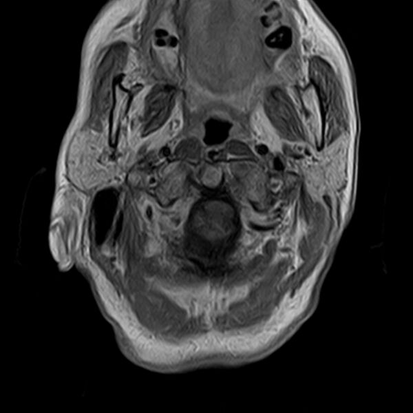 File:Calcified meningioma - cervical canal (Radiopaedia 70136-82468 Axial T1 C+ 7).jpg