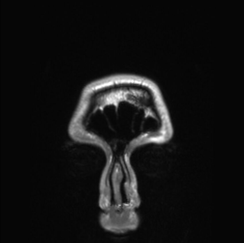 Callosal dysgenesis with interhemispheric cyst (Radiopaedia 53355-59335 Coronal T1 188).jpg
