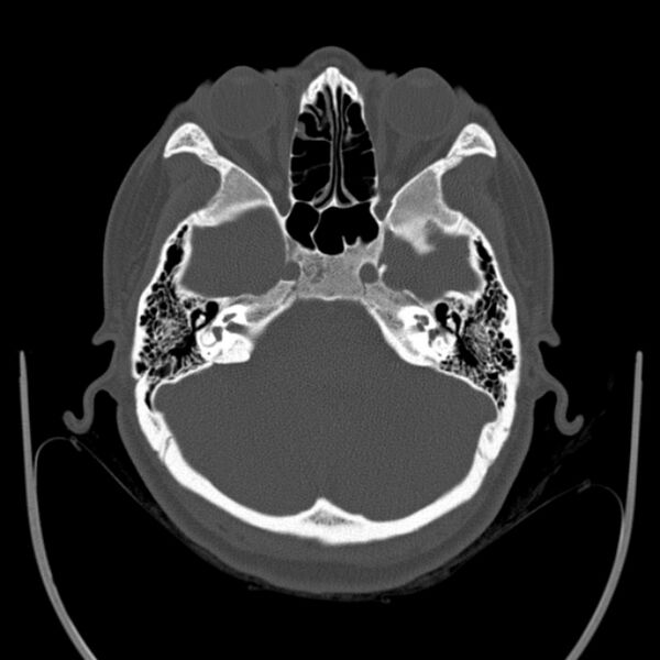 File:Calvarial osteoma (Radiopaedia 36520-38079 Axial bone window 27).jpg