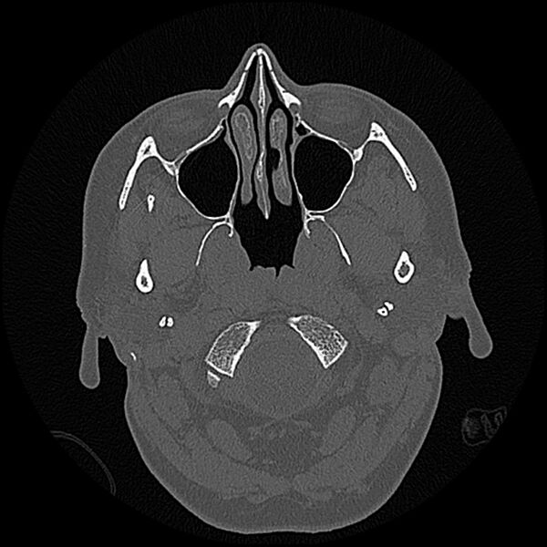 File:Canal up mastoidectomy (Radiopaedia 78108-90638 Axial bone window 1).jpg