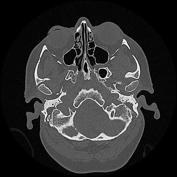 File:Canal up mastoidectomy (Radiopaedia 78108-90638 Axial bone window 30).jpg