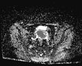 Cancer cervix - stage IIb (Radiopaedia 75411-86615 Axial ADC 21).jpg