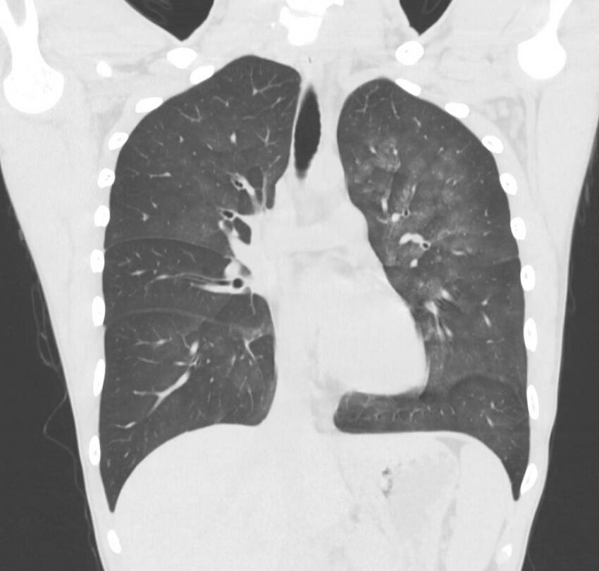 Cannabis-induced diffuse alveolar hemorrhage (Radiopaedia 89834-106946 Coronal lung window 50).jpg